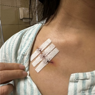 外科拉勾怎么拉突破！我院头颈外科经锁骨下入路腔镜甲状腺手术成熟，自主设计拉钩获国家级实用新型专利！_https://www.jmylbn.com_新闻资讯_第3张