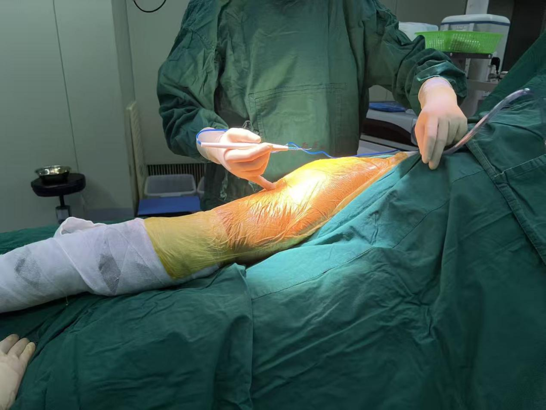 为什么手术用电刀电刀是电吗？会不会电到患者？_https://www.jmylbn.com_新闻资讯_第3张