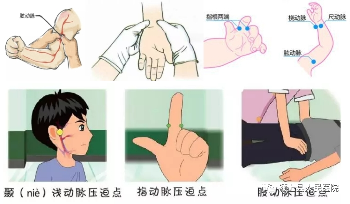 动脉什么压迫止血【科普】外伤后出血不要着急，教你几招快速止血_https://www.jmylbn.com_新闻资讯_第6张