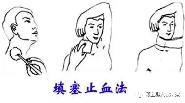 动脉什么压迫止血【科普】外伤后出血不要着急，教你几招快速止血_https://www.jmylbn.com_新闻资讯_第9张