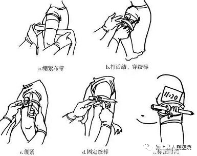 动脉什么压迫止血【科普】外伤后出血不要着急，教你几招快速止血_https://www.jmylbn.com_新闻资讯_第10张