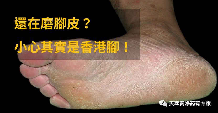足癣 香港脚 可传染的皮肤病 天萃荷净药膏专家 微信公众号文章阅读 Wemp