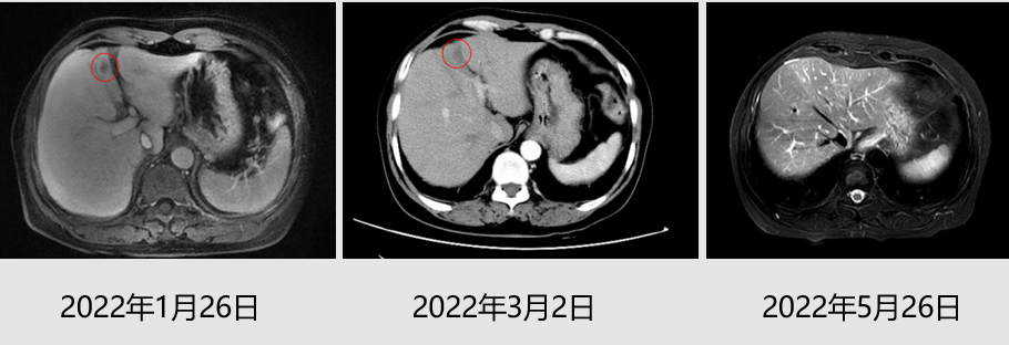 乳腺cr是什么领军疗效高度，曲帕双靶治疗HER2阳性转移性乳腺癌达CR_https://www.jmylbn.com_新闻资讯_第4张