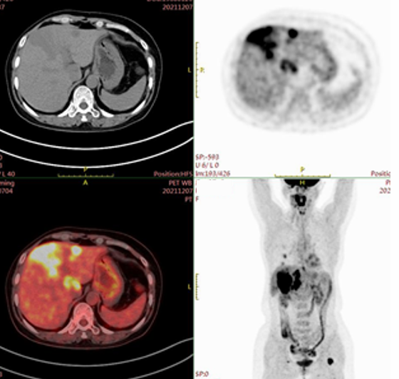 乳腺cr是什么领军疗效高度，曲帕双靶治疗HER2阳性转移性乳腺癌达CR_https://www.jmylbn.com_新闻资讯_第3张