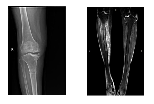 为什么负压引流【前沿技术】负压封闭引流联合Masquelet技术治疗“不死癌症”——骨髓炎_https://www.jmylbn.com_新闻资讯_第4张