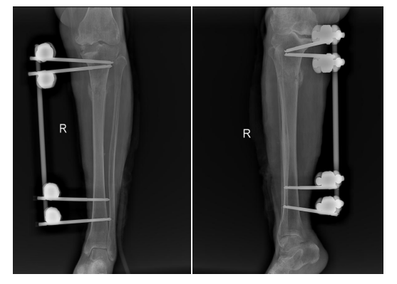 为什么负压引流【前沿技术】负压封闭引流联合Masquelet技术治疗“不死癌症”——骨髓炎_https://www.jmylbn.com_新闻资讯_第5张