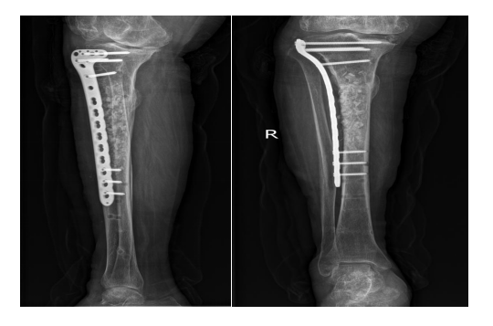 为什么负压引流【前沿技术】负压封闭引流联合Masquelet技术治疗“不死癌症”——骨髓炎_https://www.jmylbn.com_新闻资讯_第7张
