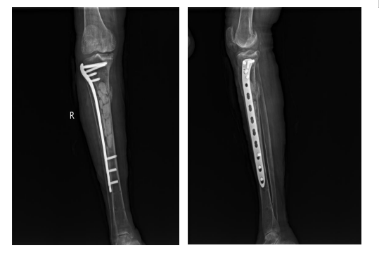为什么负压引流【前沿技术】负压封闭引流联合Masquelet技术治疗“不死癌症”——骨髓炎_https://www.jmylbn.com_新闻资讯_第6张