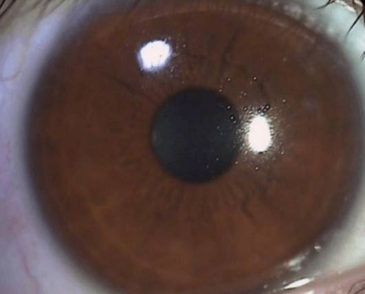 什么是裂隙灯【科普】裂隙灯下的眼睛是什么样的？_https://www.jmylbn.com_新闻资讯_第9张