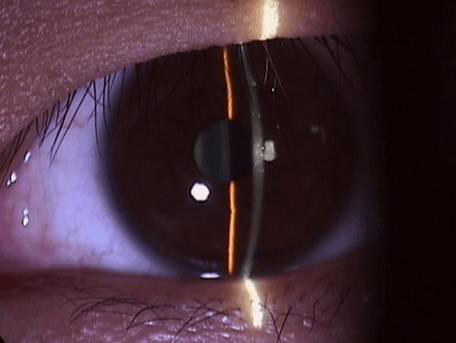 什么是裂隙灯【科普】裂隙灯下的眼睛是什么样的？_https://www.jmylbn.com_新闻资讯_第14张