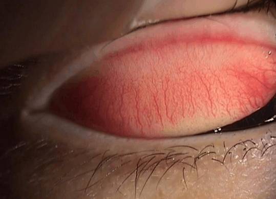 什么是裂隙灯【科普】裂隙灯下的眼睛是什么样的？_https://www.jmylbn.com_新闻资讯_第10张