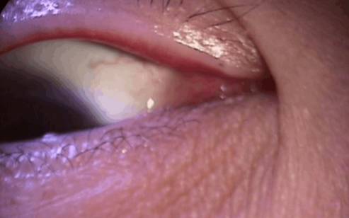 什么是裂隙灯【科普】裂隙灯下的眼睛是什么样的？_https://www.jmylbn.com_新闻资讯_第8张