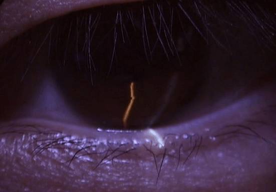 什么是裂隙灯【科普】裂隙灯下的眼睛是什么样的？_https://www.jmylbn.com_新闻资讯_第12张