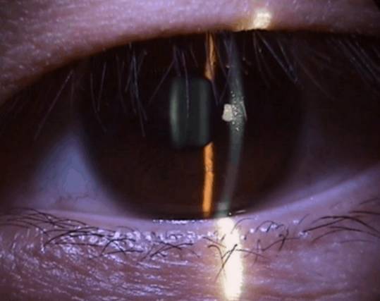 什么是裂隙灯【科普】裂隙灯下的眼睛是什么样的？_https://www.jmylbn.com_新闻资讯_第11张