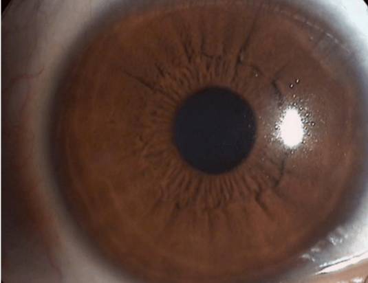 什么是裂隙灯【科普】裂隙灯下的眼睛是什么样的？_https://www.jmylbn.com_新闻资讯_第13张