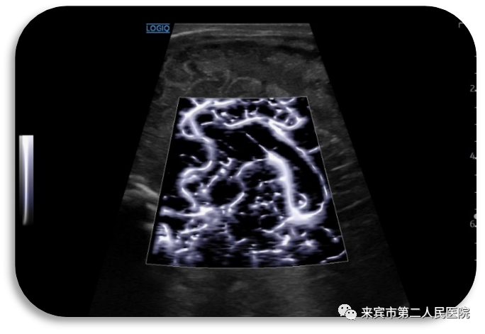 彩超logiq怎么读来宾市第二人民医院引进进口GE彩超，影像更清晰_https://www.jmylbn.com_新闻资讯_第9张