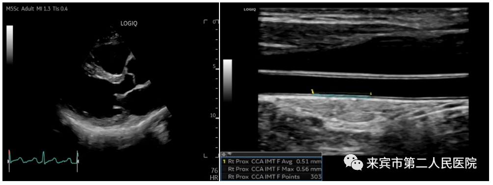 彩超logiq怎么读来宾市第二人民医院引进进口GE彩超，影像更清晰_https://www.jmylbn.com_新闻资讯_第4张