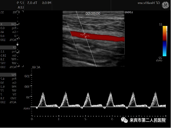 彩超logiq怎么读来宾市第二人民医院引进进口GE彩超，影像更清晰_https://www.jmylbn.com_新闻资讯_第6张