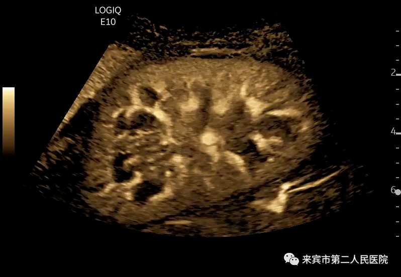 彩超logiq怎么读来宾市第二人民医院引进进口GE彩超，影像更清晰_https://www.jmylbn.com_新闻资讯_第8张