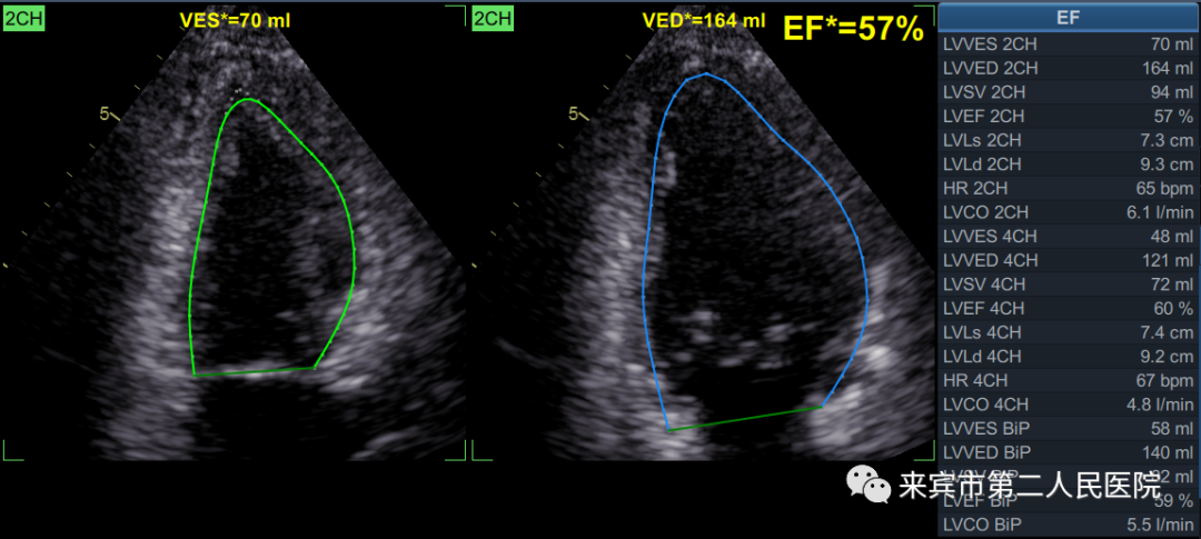 彩超logiq怎么读来宾市第二人民医院引进进口GE彩超，影像更清晰_https://www.jmylbn.com_新闻资讯_第7张