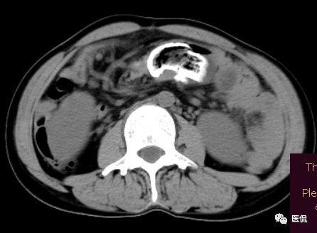 医用纱布有什么规格手术后医用纱布被落在体内忘记取出，会有什么后果？来看看CT_https://www.jmylbn.com_新闻资讯_第6张