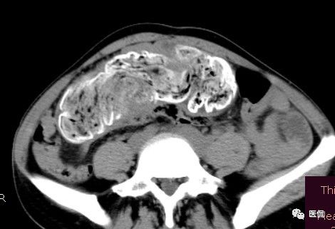 医用纱布有什么规格手术后医用纱布被落在体内忘记取出，会有什么后果？来看看CT_https://www.jmylbn.com_新闻资讯_第9张