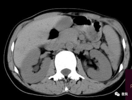 医用纱布有什么规格手术后医用纱布被落在体内忘记取出，会有什么后果？来看看CT_https://www.jmylbn.com_新闻资讯_第3张