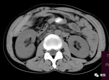 医用纱布有什么规格手术后医用纱布被落在体内忘记取出，会有什么后果？来看看CT_https://www.jmylbn.com_新闻资讯_第4张