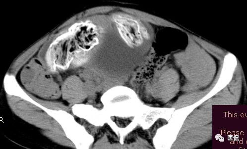 医用纱布有什么规格手术后医用纱布被落在体内忘记取出，会有什么后果？来看看CT_https://www.jmylbn.com_新闻资讯_第11张