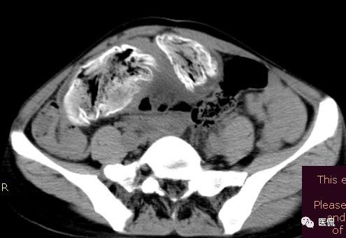 医用纱布有什么规格手术后医用纱布被落在体内忘记取出，会有什么后果？来看看CT_https://www.jmylbn.com_新闻资讯_第10张