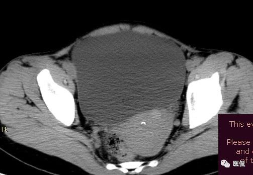 医用纱布有什么规格手术后医用纱布被落在体内忘记取出，会有什么后果？来看看CT_https://www.jmylbn.com_新闻资讯_第14张