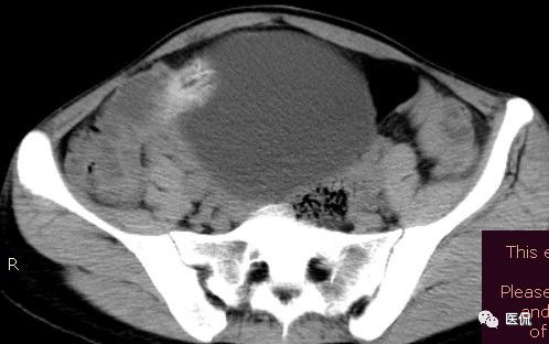 医用纱布有什么规格手术后医用纱布被落在体内忘记取出，会有什么后果？来看看CT_https://www.jmylbn.com_新闻资讯_第12张
