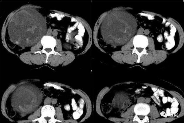 医用纱布有什么规格手术后医用纱布被落在体内忘记取出，会有什么后果？来看看CT_https://www.jmylbn.com_新闻资讯_第17张