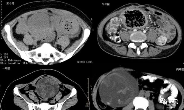 医用纱布有什么规格手术后医用纱布被落在体内忘记取出，会有什么后果？来看看CT_https://www.jmylbn.com_新闻资讯_第15张