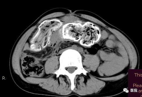 医用纱布有什么规格手术后医用纱布被落在体内忘记取出，会有什么后果？来看看CT_https://www.jmylbn.com_新闻资讯_第8张