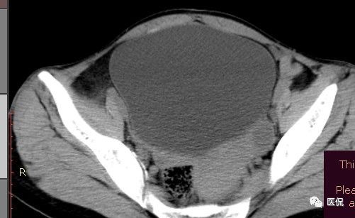 医用纱布有什么规格手术后医用纱布被落在体内忘记取出，会有什么后果？来看看CT_https://www.jmylbn.com_新闻资讯_第13张