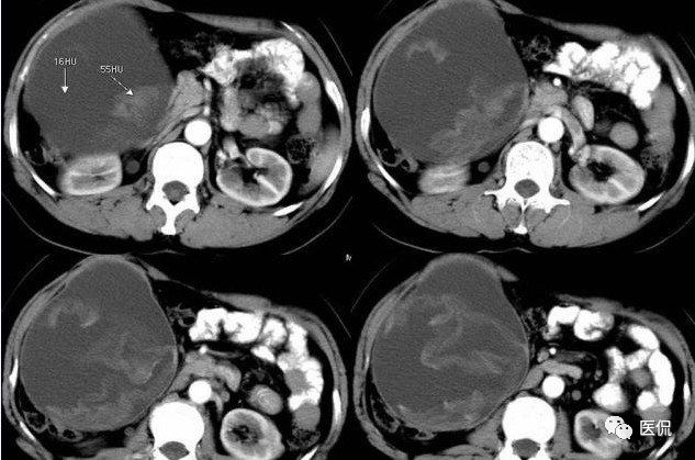 医用纱布有什么规格手术后医用纱布被落在体内忘记取出，会有什么后果？来看看CT_https://www.jmylbn.com_新闻资讯_第18张