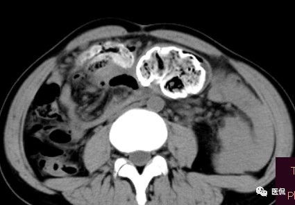 医用纱布有什么规格手术后医用纱布被落在体内忘记取出，会有什么后果？来看看CT_https://www.jmylbn.com_新闻资讯_第7张
