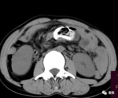 医用纱布有什么规格手术后医用纱布被落在体内忘记取出，会有什么后果？来看看CT_https://www.jmylbn.com_新闻资讯_第5张