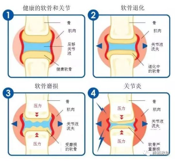 终板软骨图片