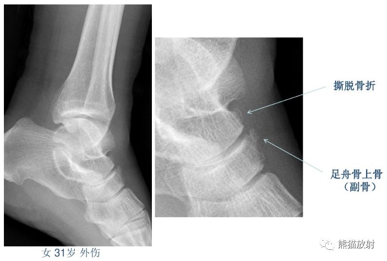 籽骨,副骨,永存骨骺,撕脫骨折_醫學界-助力醫生臨床決策和職業成長