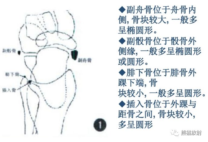 肌腱韌帶附著處的骨質拉斷,撕脫,如股骨大,小轉子,肱骨內,外上髁等