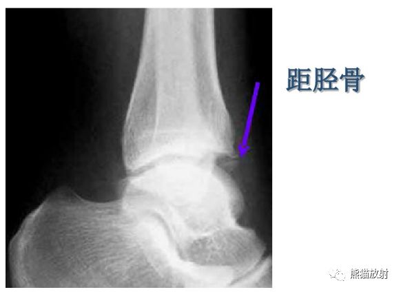 籽骨,副骨,永存骨骺,撕脫骨折_醫學界-助力醫生臨床決策和職業成長