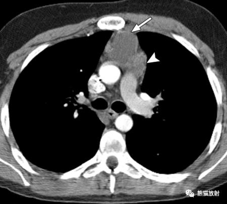 上皮性腫瘤(包括胸腺瘤和胸腺癌),淋巴瘤(包括hl和nhl),朗格漢斯細胞