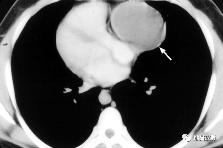 27歲女性,胸腺瘤.左心室水平的ct增強掃描顯示胸腺實性腫塊,有強化.