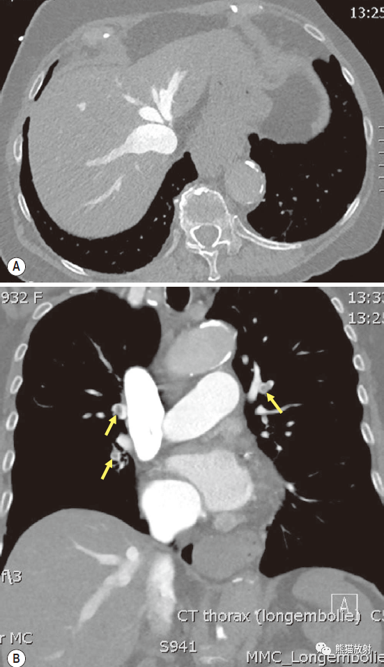 肺门残根征_医学界-助力医生临床决策和职业成长
