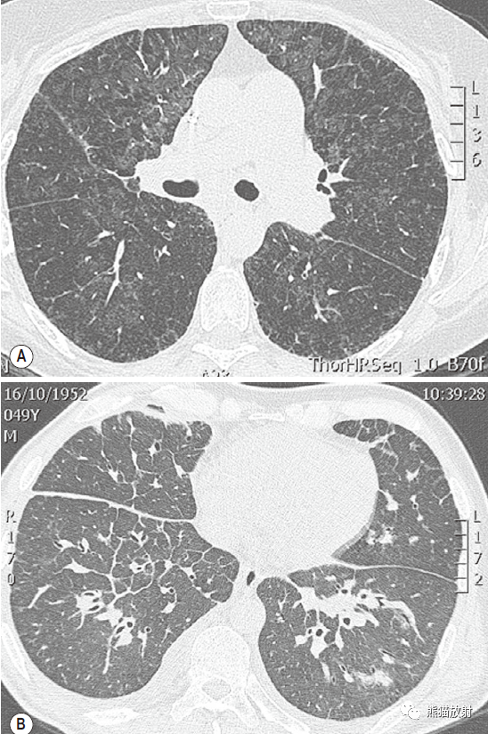 肺门残根征_医学界-助力医生临床决策和职业成长