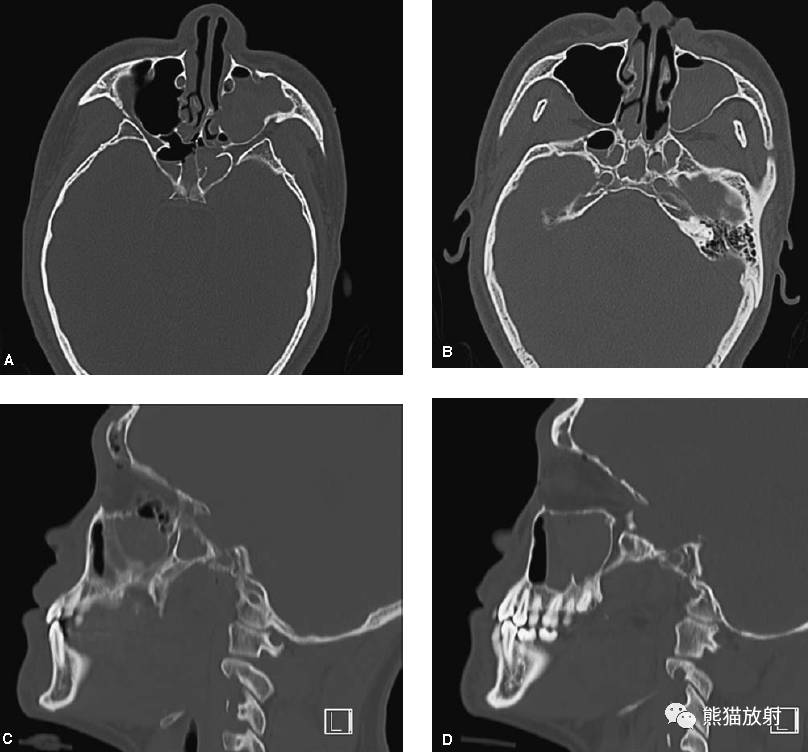 【急诊】颧骨骨折,上颌骨骨折ct表现_医学界-助力医生临床决策和职业