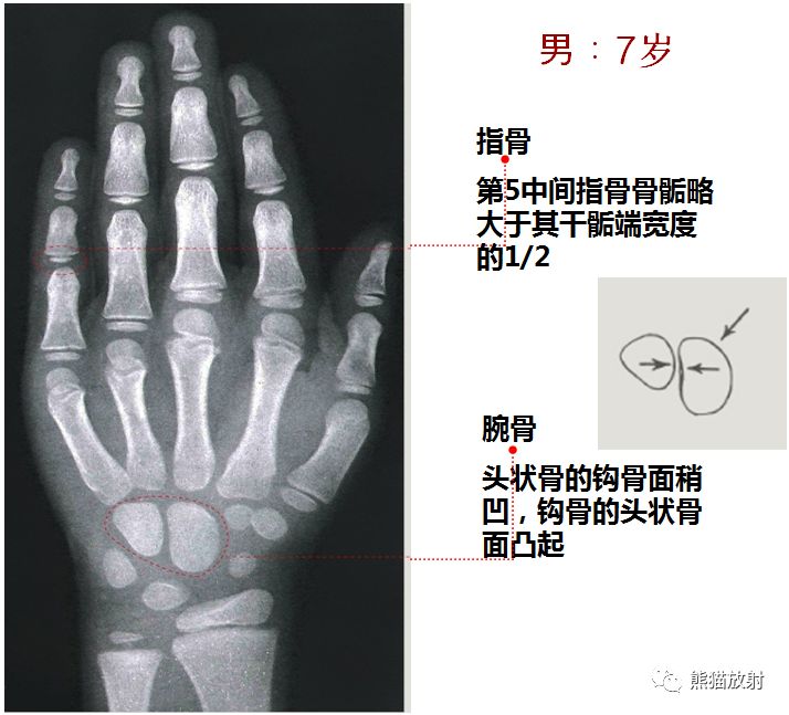 务必收藏丨最全骨龄图谱!