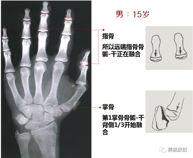 男孩骨龄图谱女孩骨龄图谱上图中的数字为相应骨出现时的年龄骨龄评估